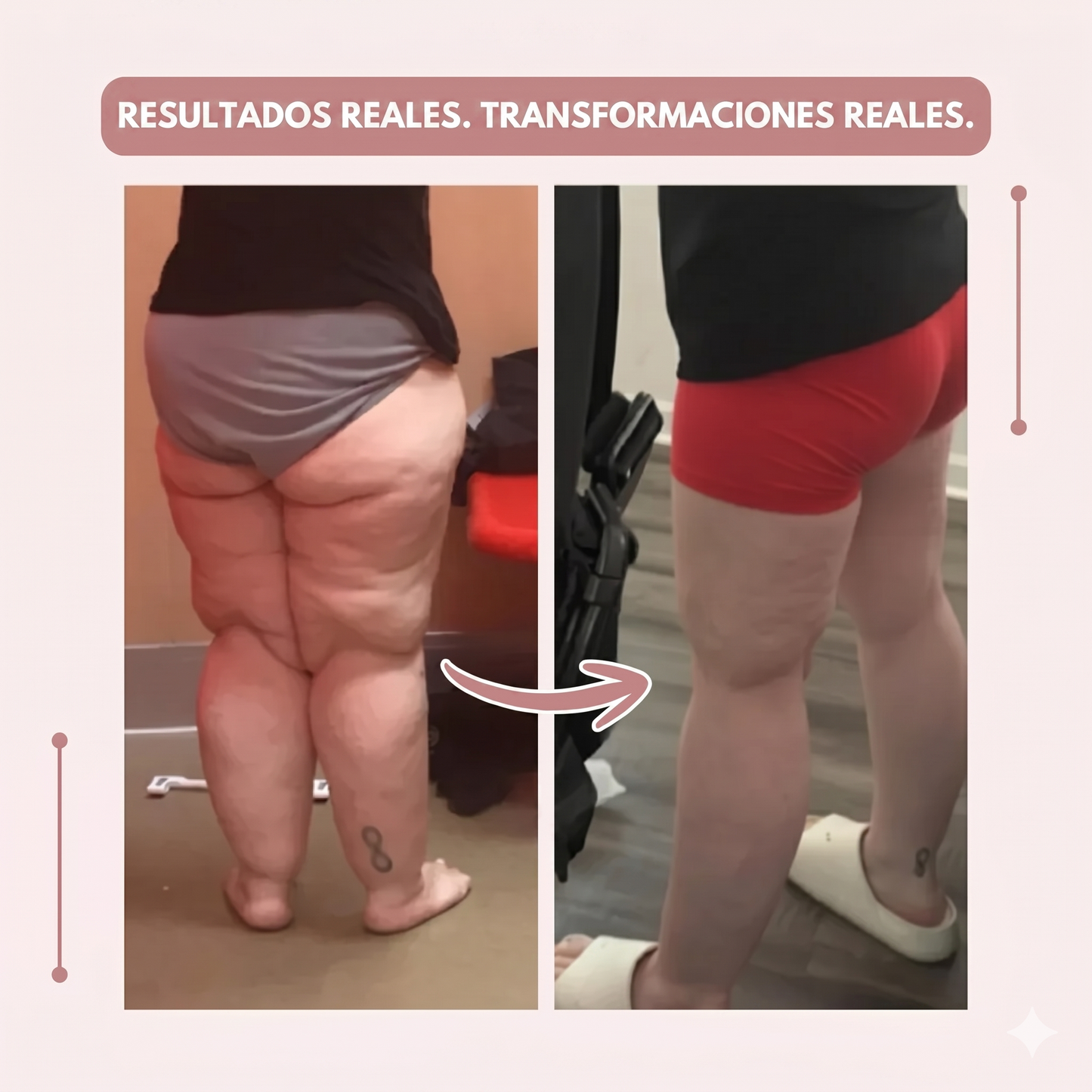 Clara Serra | Mallas 3D: alivié de forma natural el dolor y la hinchazón del lipedema