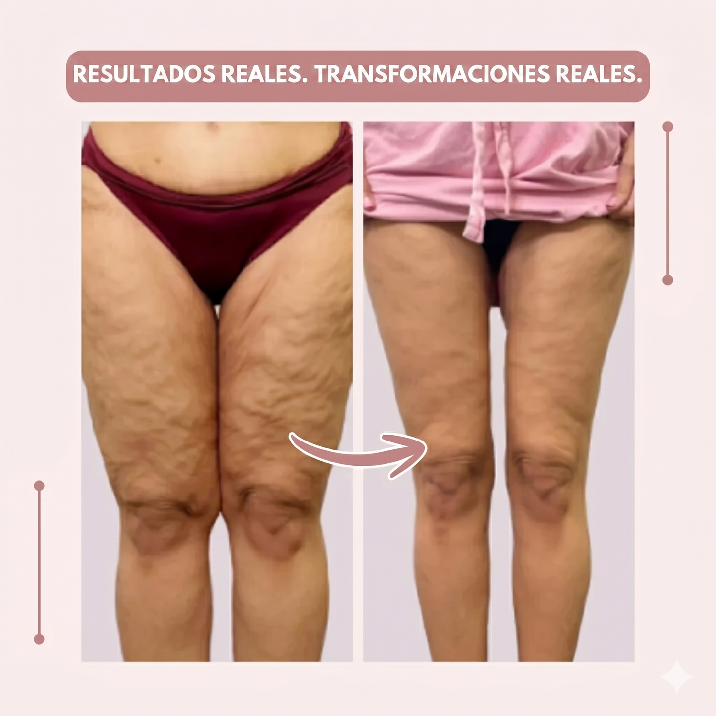 Clara Serra | Mallas 3D: alivié de forma natural el dolor y la hinchazón del lipedema