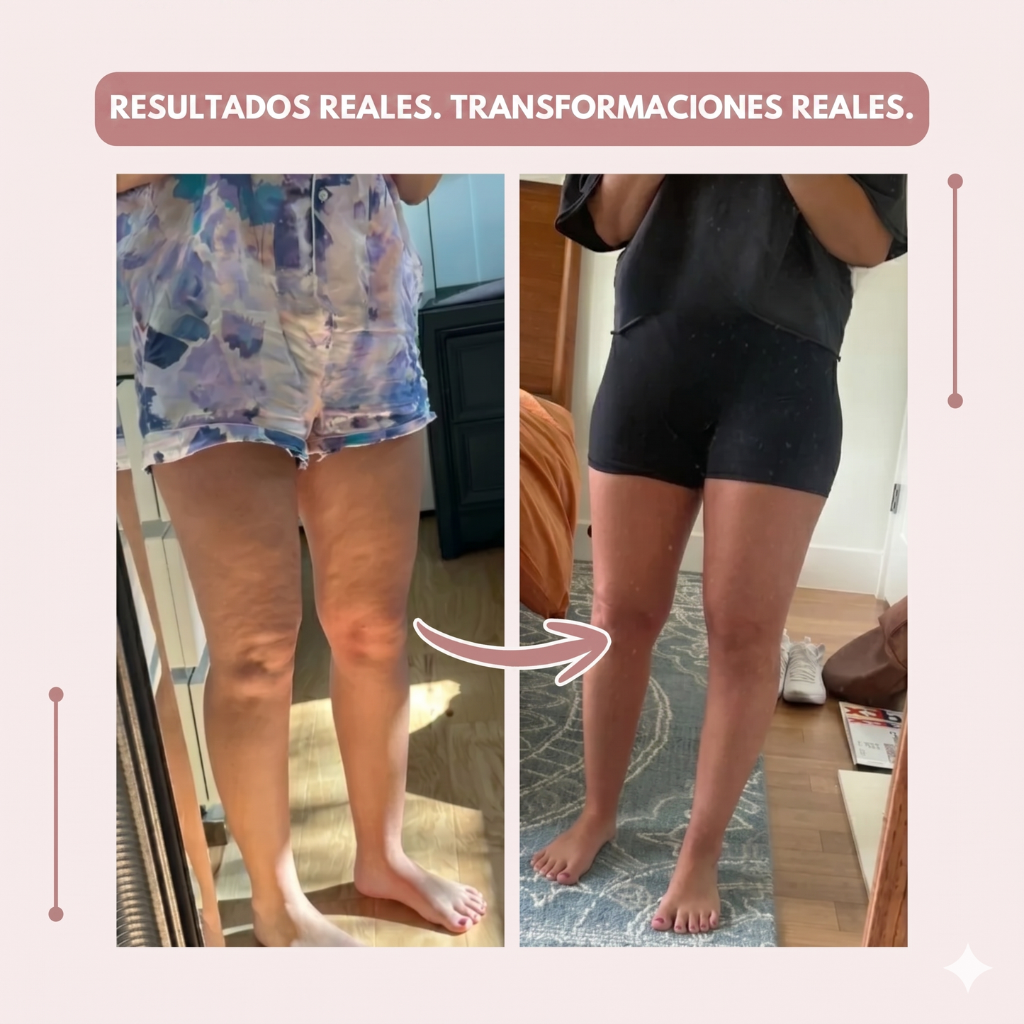 Clara Serra | Mallas 3D: alivié de forma natural el dolor y la hinchazón del lipedema