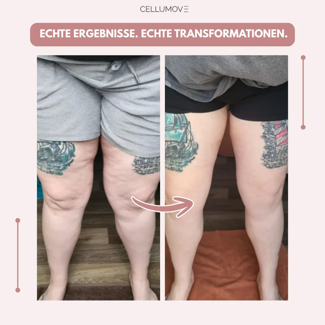 Clara Serra | Mallas 3D: alivié de forma natural el dolor y la hinchazón del lipedema
